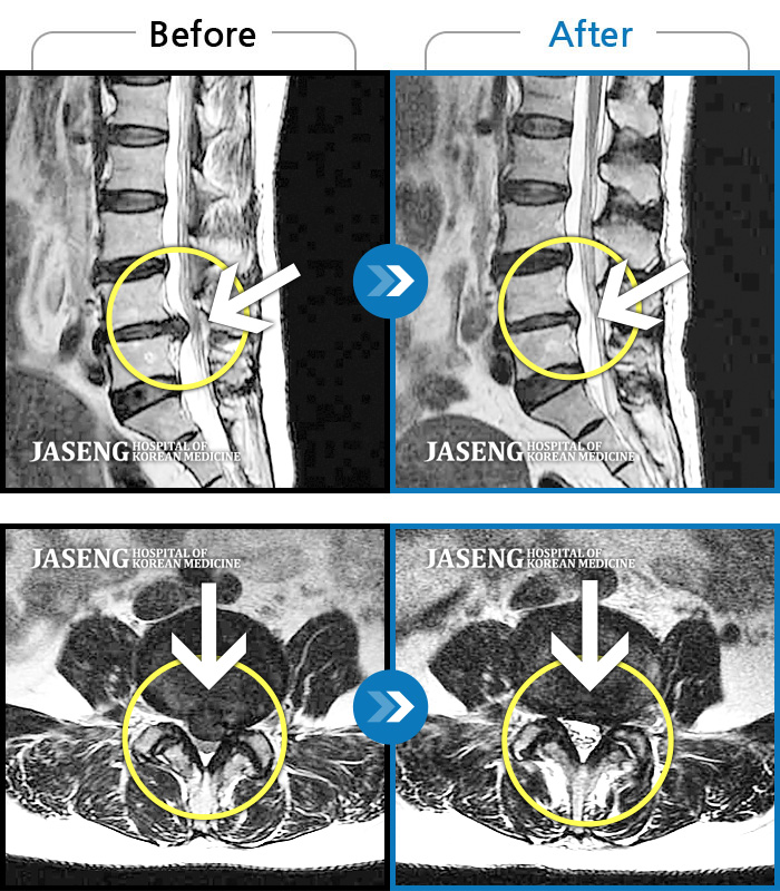 안산자생한방병원 치료사례 MRI로 보는 치료결과-허리에서 골반으로 내려가는 심한 통증, 바로 눕기 어려운 상태