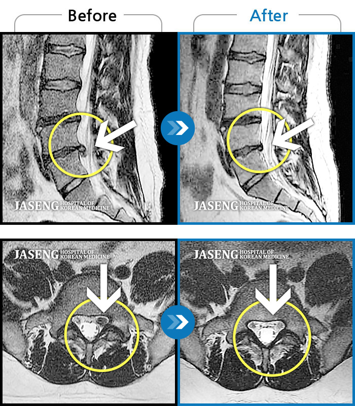 안산자생한방병원 치료사례 MRI로 보는 치료결과-허리 통증과 심한 좌측 다리 통증