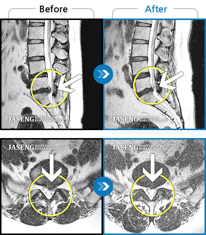 안산자생한방병원 치료사례 MRI로 보는 치료결과-극심한 허리통증과 우측 대퇴저림으로 일상생활 불가능