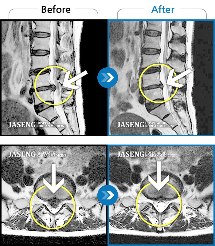 안산자생한방병원 치료사례 MRI로 보는 치료결과-왼쪽 허리에서 다리로 내려가는 심한 통증과 하지의 근력 저하가 나타나 편하게 걷지 못하였습니다.