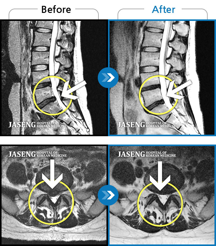 안산자생한방병원 치료사례 MRI로 보는 치료결과-허리 통증 및 오른쪽 다리로 내려가는 심한 통증으로 혼자 보행 어려워 응급 내원