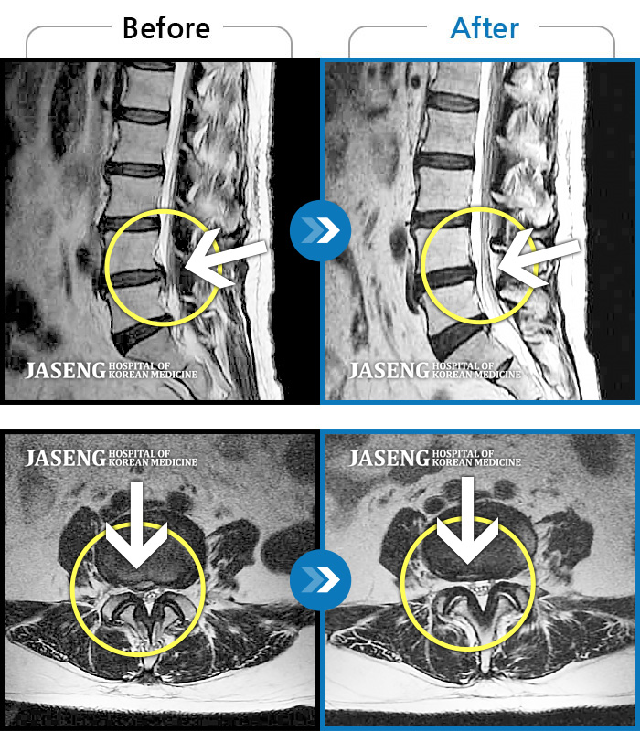 안산자생한방병원 치료사례 MRI로 보는 치료결과-허리통증과 오른쪽 다리로 내려가는 심한 통증으로 거동이 힘든 상태였습니다.
