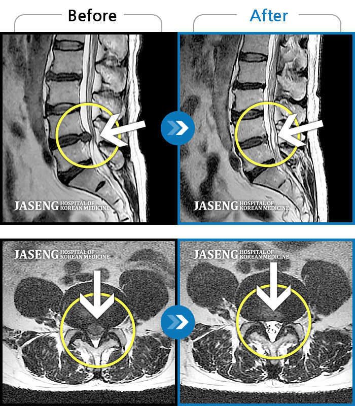 안산자생한방병원 치료사례 MRI로 보는 치료결과-허리에서 양측 다리 뒤로 방사되는 통증이 극심한 상태로 몇걸음도 걷기 힘들었다.
