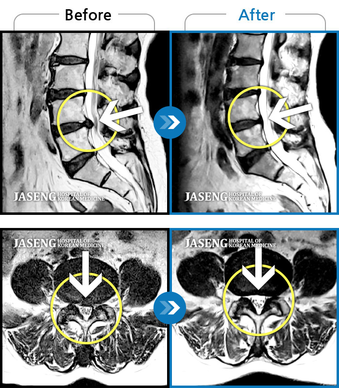 Ȼڻѹ溴 ġ MRI  ġ-㸮 ϻ .