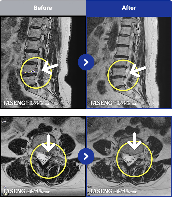 ��õ�ڻ��ѹ溴�� ġ���� MRI�� ���� ġ����-�㸮�� �ʹ� ������ �ٸ��� ������