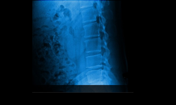안산자생한방병원 허리질환 척추후만증-척추후만증에 관련된 이미지 입니다.