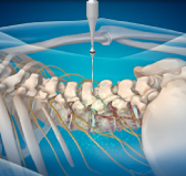 안산자생한방병원 허리치료법 신경근회복술-신경근회복술의 특징 두번째 관련 사진 입니다.