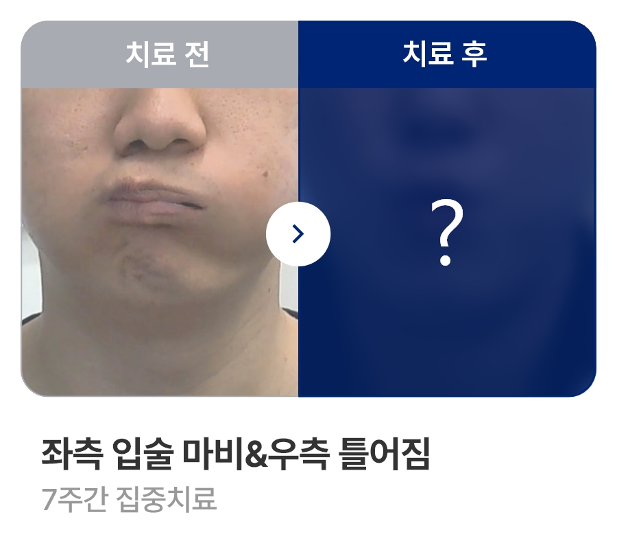 좌측 입술 마비&우측 틀어짐 / 7주간 집중치료