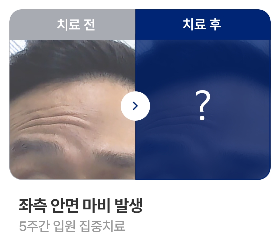 좌측 안면 마비 발생 / 5주간 입원 집중치료